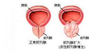 男子前列腺增生如何预防